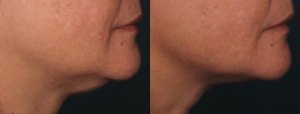 Ultherapy by Ulthera