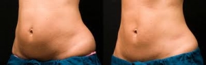 CoolSculpting by Zeltiq