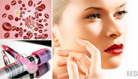 PRP Platelet Rich Plasma Rejuvenation Therapy at Milady Medical Spa Brooklyn NY 11235
