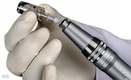 PRP Platelet Rich Plasma Rejuvenation Therapy at Milady Medical Spa Brooklyn NY 11235