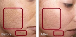PRP Platelet Rich Plasma Rejuvenation Therapy at Milady Medical Spa Brooklyn NY 11235