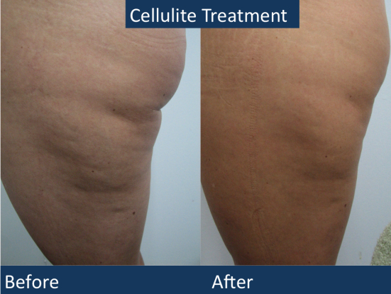 Cellulite Reduction Treatment Brooklyn Spa 11235