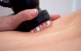 Radio Frequency Fat Reduction Treatment
