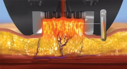 Radio Frequency Fat Reduction Technology
