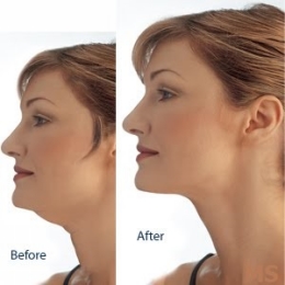 Double Chin Before After Treatments at Milady Medical Spa Brooklyn NY 11235