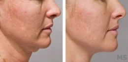 Double Chin Before After Treatments at Milady Medical Spa Brooklyn NY 11235