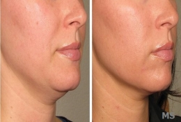 Double Chin Before After Treatments at Milady Medical Spa Brooklyn NY 11235
