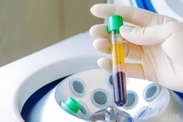 PRP Platelet Rich Plasma Hair Regrowth Restoration Therapy at Milady Medical Spa Brooklyn NY 11235