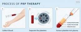 PRP Platelet Rich Plasma Hair Regrowth Restoration Therapy at Milady Medical Spa Brooklyn NY 11235