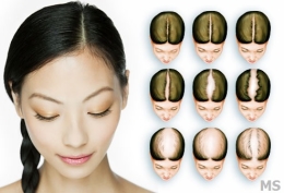 Hair Loss Treatment at Milady Medical Spa Brooklyn NY 11235