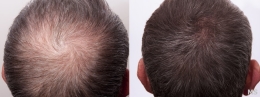Hair Loss Treatment at Milady Medical Spa Brooklyn NY 11235