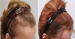 Hair Loss Treatment at Milady Medical Spa Brooklyn NY 11235