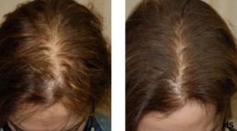 Hair Loss Treatment at Milady Medical Spa Brooklyn NY 11235