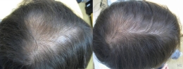 Hair Loss Treatment at Milady Medical Spa Brooklyn NY 11235