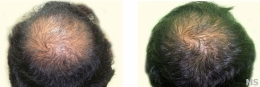 Hair Loss Treatment at Milady Medical Spa Brooklyn NY 11235