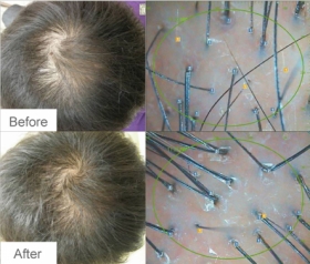 Hair Regrowth Mesotherapy Before After at Milady Spa