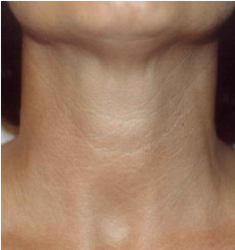 Mesotherapy