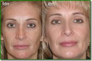 Microdermabrasion Before and After