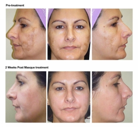 Jessner Peel at Milady Spa