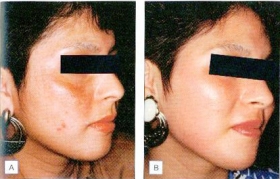Jessner Peel Brooklyn NY Before After