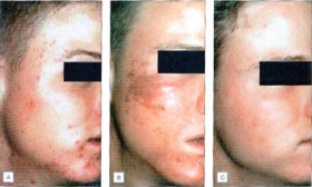Jessner Peel - Great treatment for all skin types.