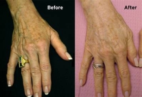 Jessner Peel for Hands