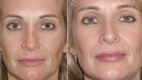 Diamond Microdermabrasion Before After