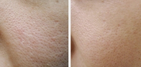 Diamond Microdermabrasion Pore Reduction Before After