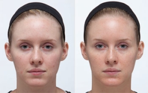 RetinA Peel