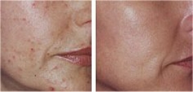 TCA peel at Milady Spa
