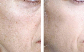 TCA peel before after (1 treatment)