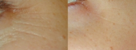 TCA peel Around Eyes Wrinkle Reduction Treatment