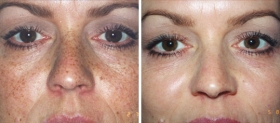 TCA peel Pigmentation treatment Before After