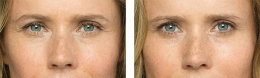 Radio Frequency Treatment Eye Dark Circles Milady Medical Spa Brooklyn NY 11235