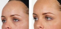 Belotero Eye Dark Circles Milady Medical Spa Brooklyn NY 11235