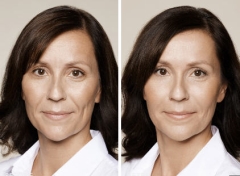 Eye Dark Circles Milady Medical Spa Brooklyn NY 11235