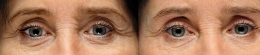 Restylane Eye Dark Circles Milady Medical Spa Brooklyn NY 11235
