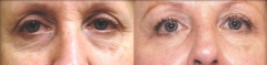 Sciton Skintyte Eye Dark Circles Milady Medical Spa Brooklyn NY 11235